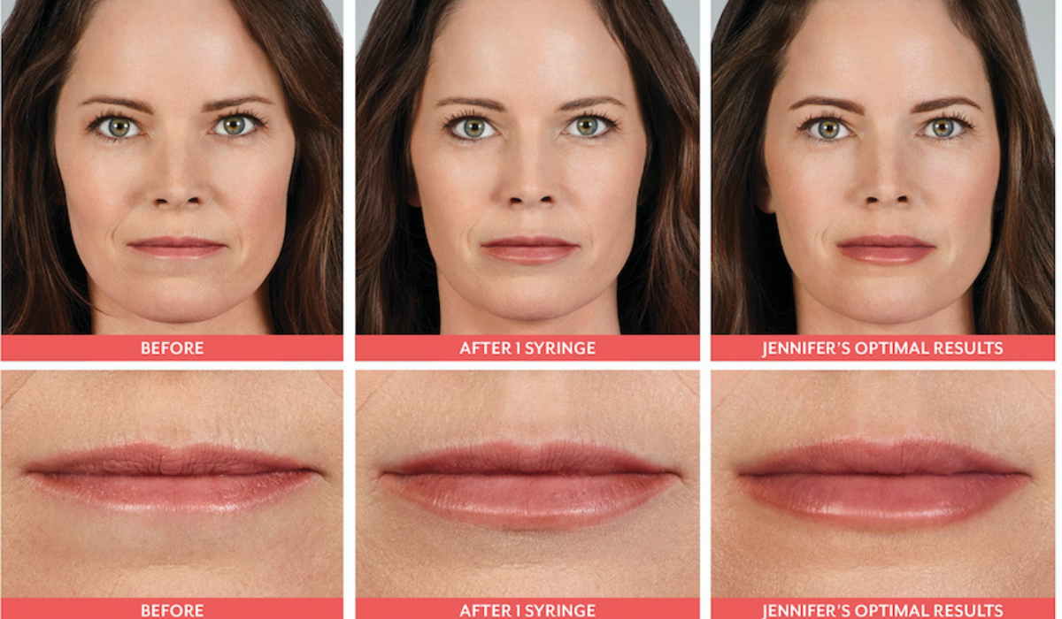 juvederm ultra xc